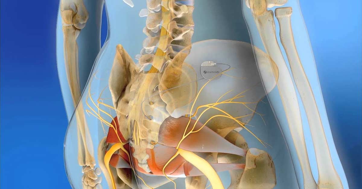 Sakral Nöromodülasyon (Mesane Pili) Tedavisi 