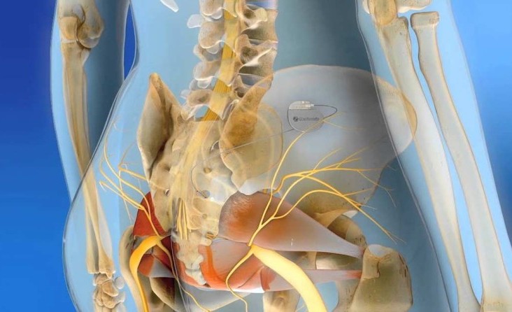 Sakral Nöromodülasyon (Mesane Pili) Tedavisi 