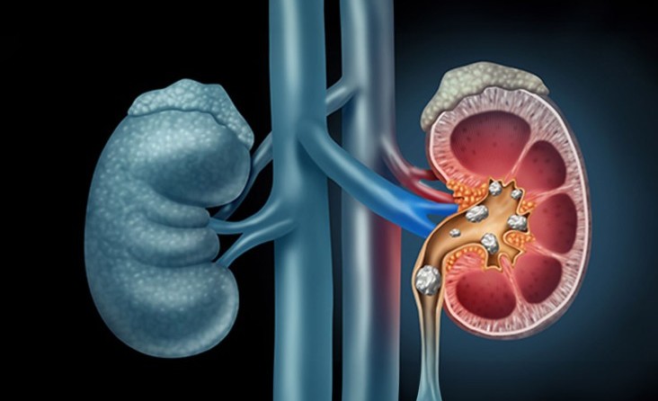 Böbrek Taşı