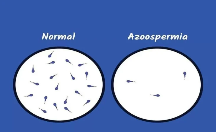 Azospermi