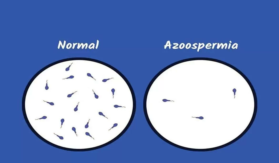 Azospermi
